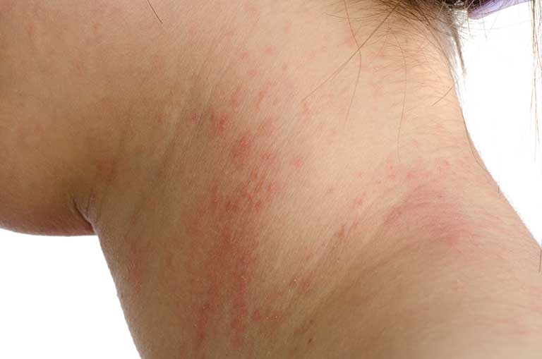Symptoms of Atopic dermatitis.jpg